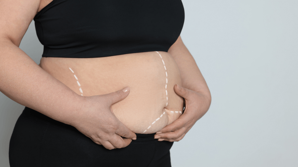 Bariatric surgery candidate with abdominal obesity Woman holding abdominal area as a common sign of obesity and candidate for bariatric surgery