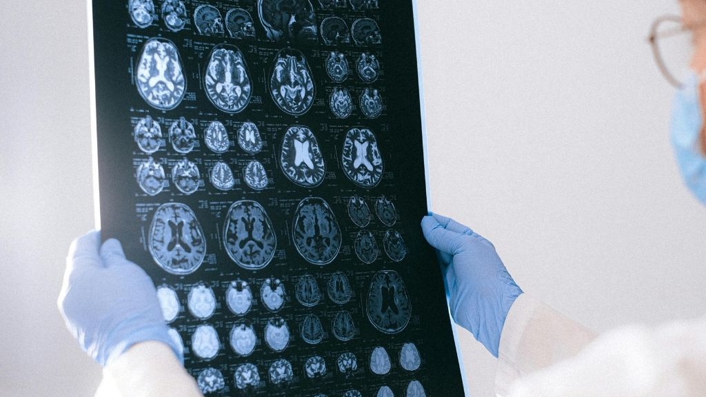Avaluació per ressonància magnètica cerebral per a cirurgia d'epilèpsia a Barcelona